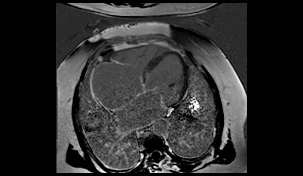 CT image of retro-ocular masses causing exophthalmos along with bilateral perinephric, pericardial, and pelvic exudates