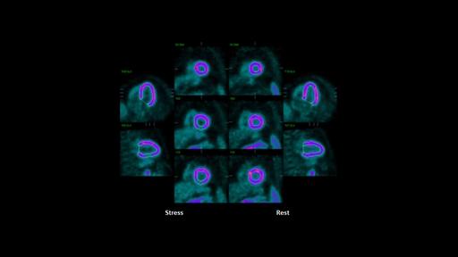 PET/CT delineation of multivessel coronary artery disease and post ...