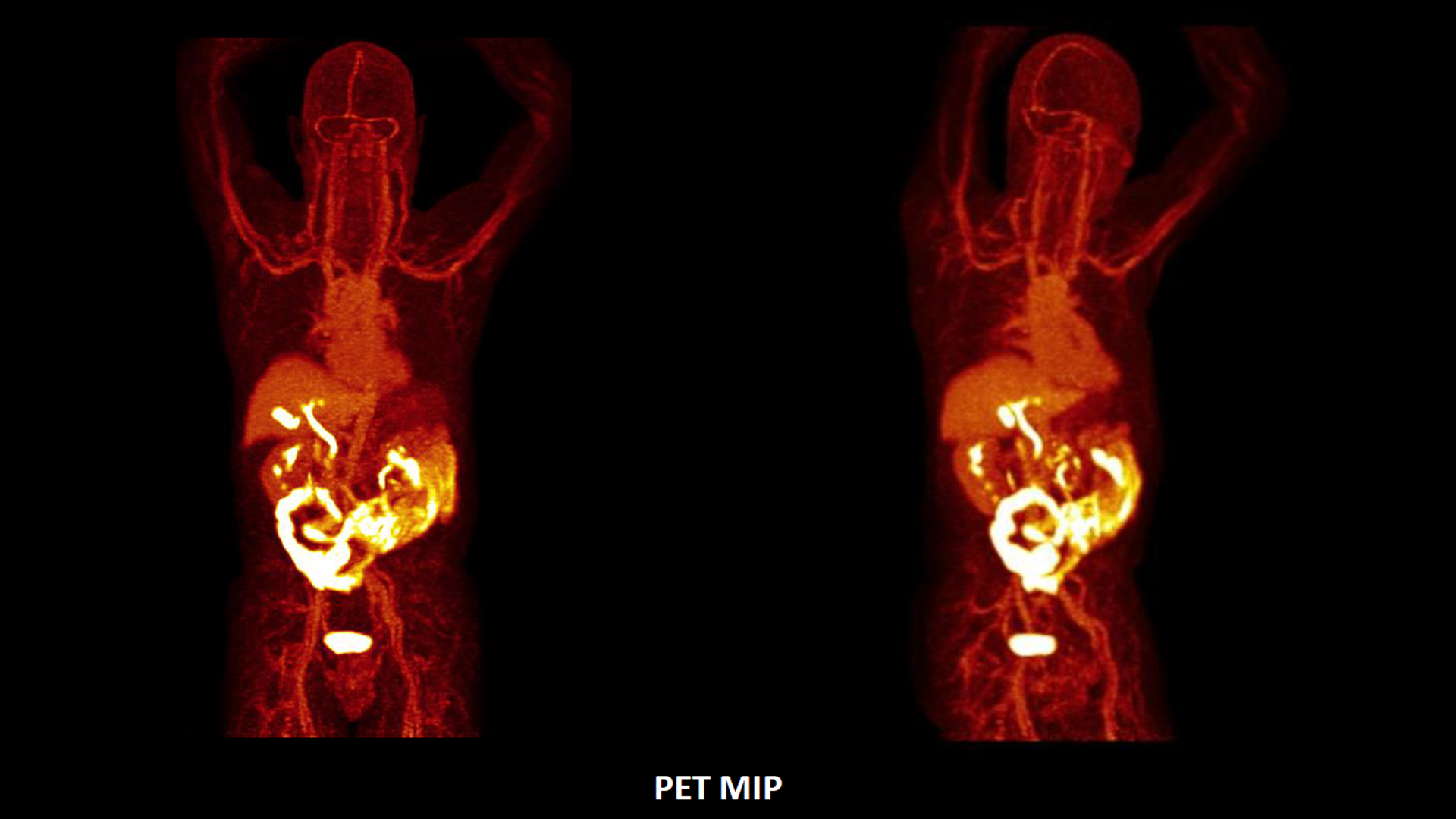 Biograph Vision PET/CT - Siemens Healthineers USA
