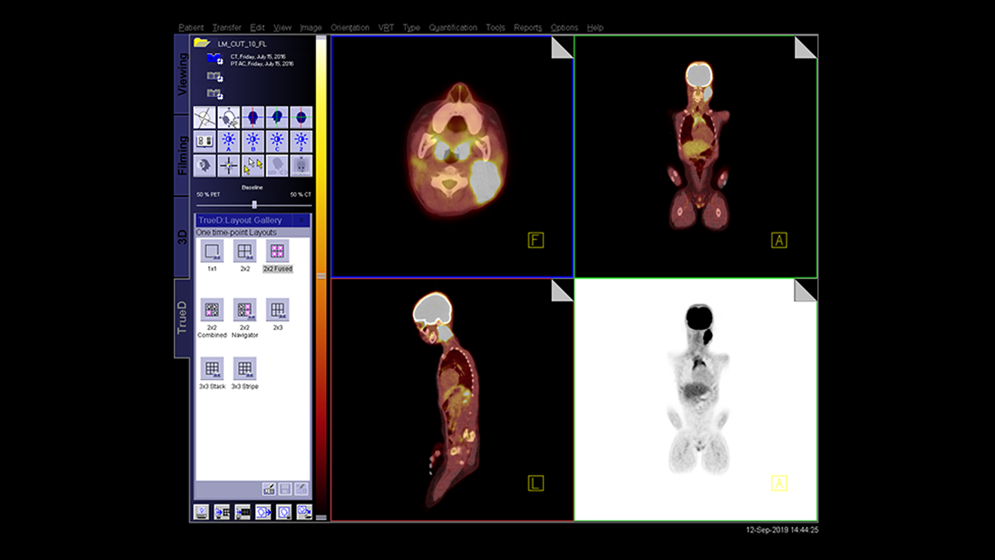 Siemens Healthineers body scan from PET/CT using FAST PET Workflow AI.