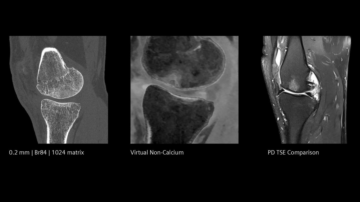 Photon-counting CT scan of a knee bone marrow evaluation with Quantum HD and Quantum Spectral Imaging