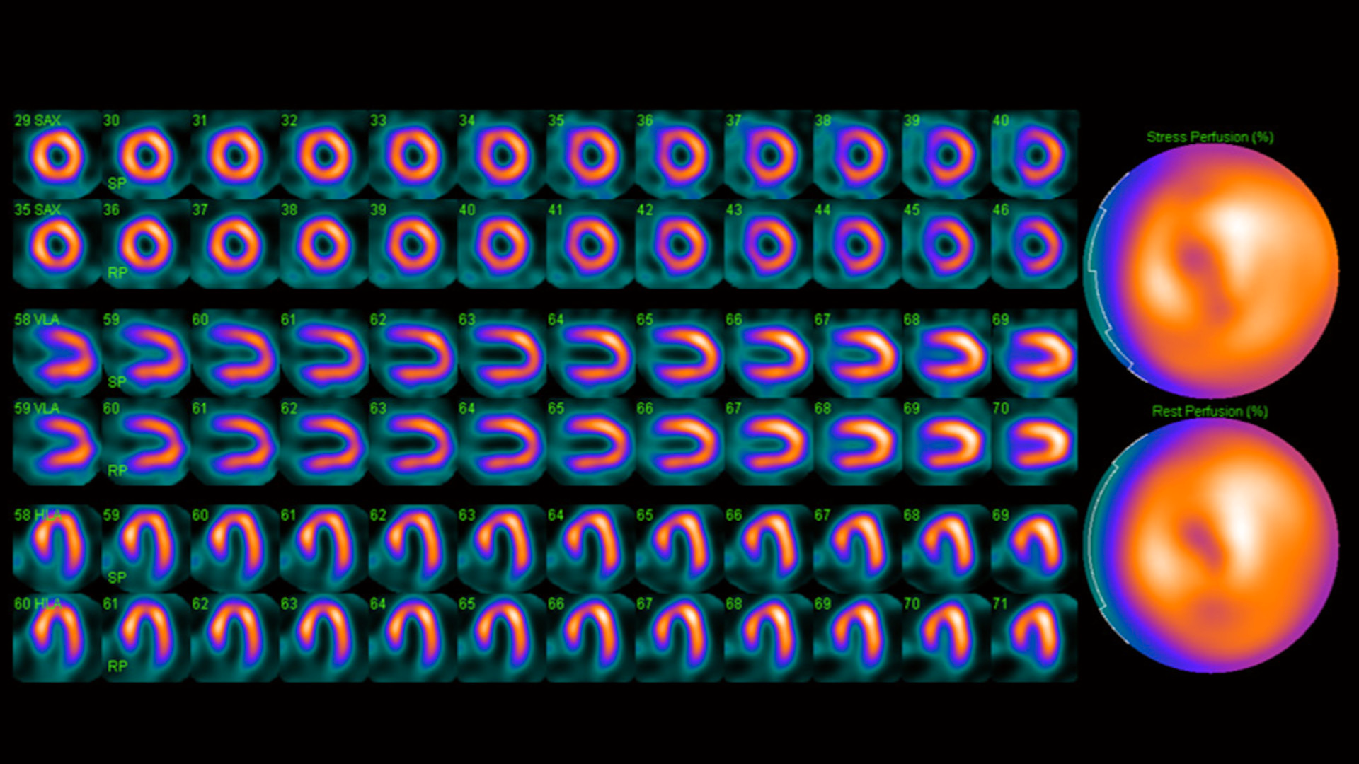 IQ•SPECT: a technical and clinical overview - Siemens Healthineers