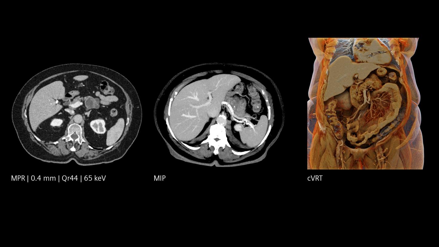 Pancreatic imaging of a patient with high BMI