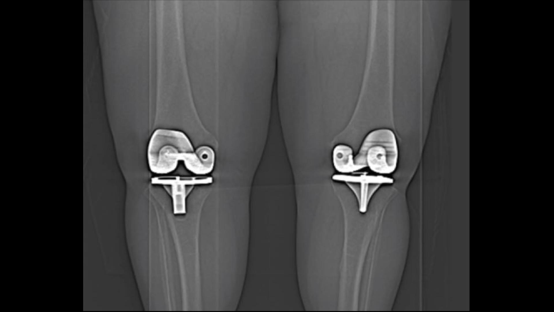 SPECT/CT Detection In TKA Prosthetic Loosening Siemens Healthineers SPECT/CT Detection In TKA Prosthetic Loosening Siemens Healthineers