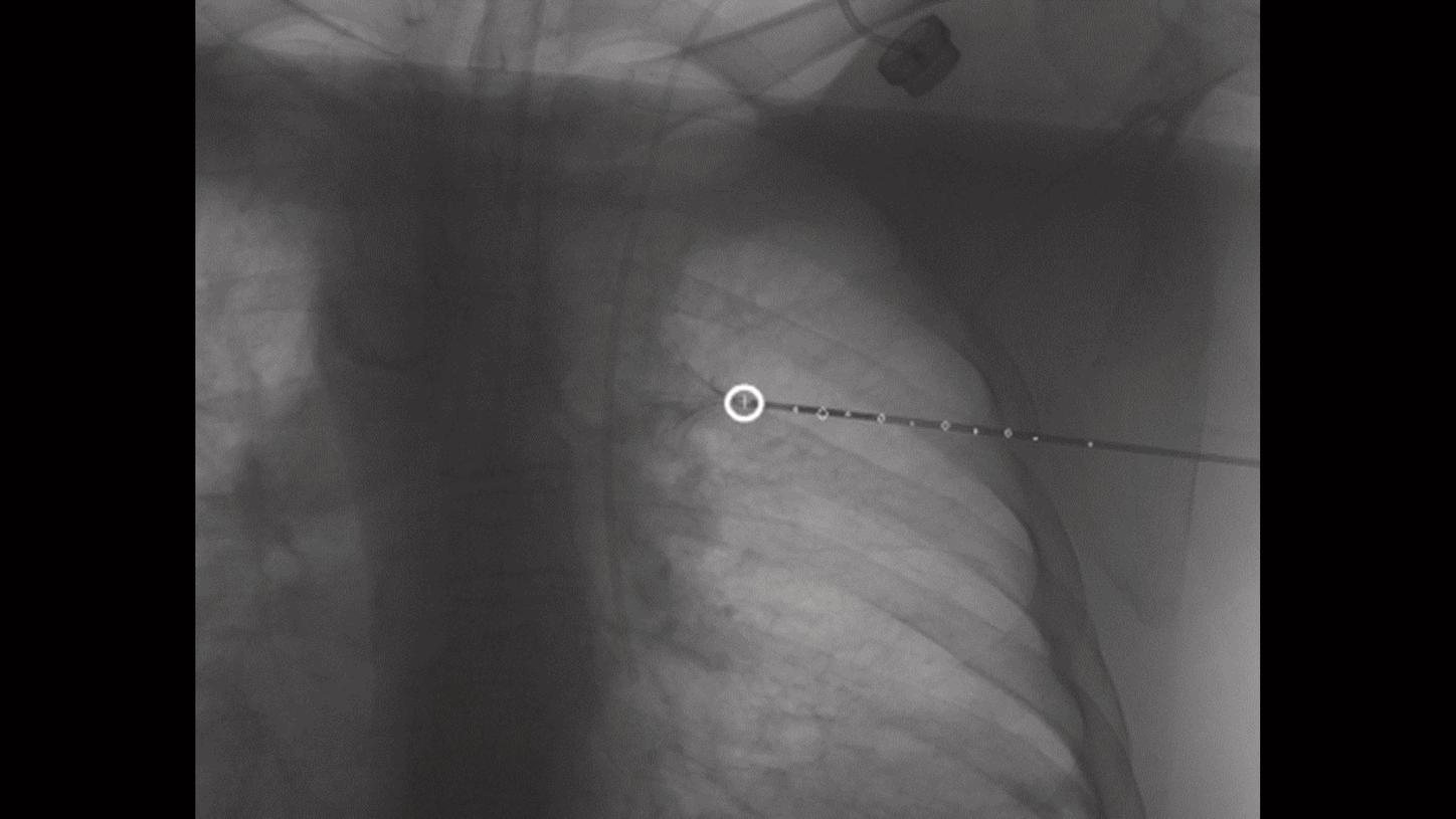 Clinical image showing progression views of a planned needle path and target superimposed on live fluoroscopy