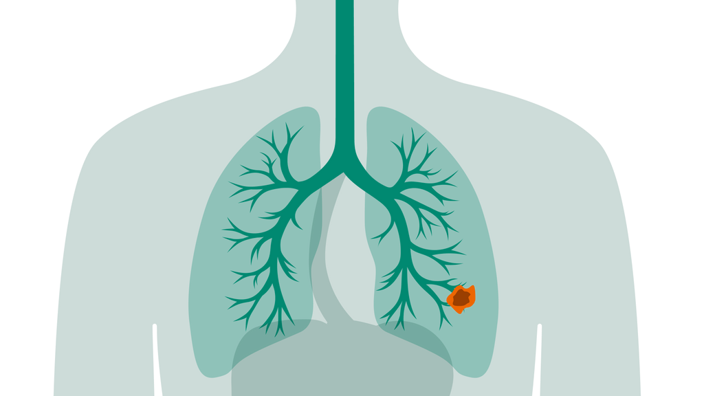 Lung Cancer Patient Journey Siemens Healthineers