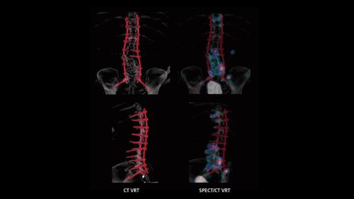 SPECT/CT imaging in the evaluation of pain following spinal fusion ...