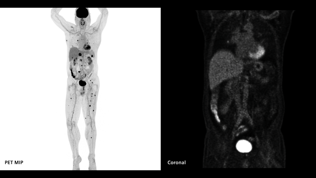 Biograph Vision clinical case