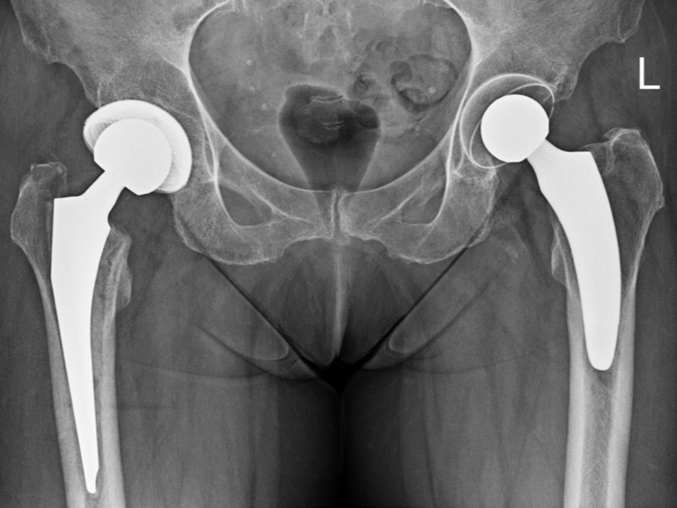 X-ray of hips