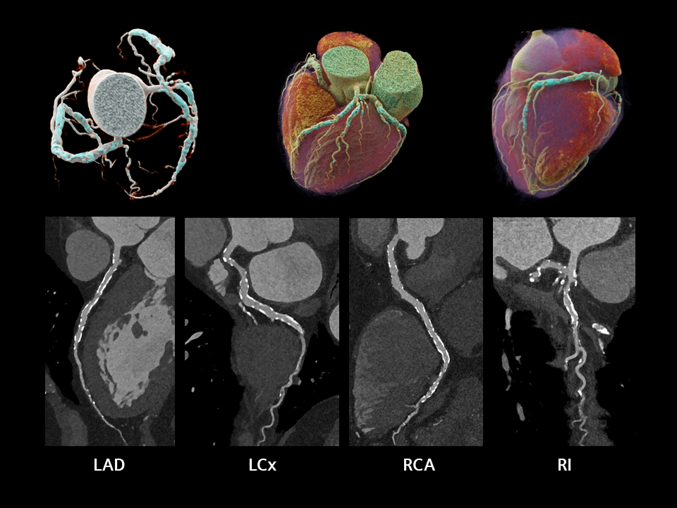 Cinematic volume-rendered technique (cVRT) images from CCTA, illustrating the three-dimensional coronary artery tree.