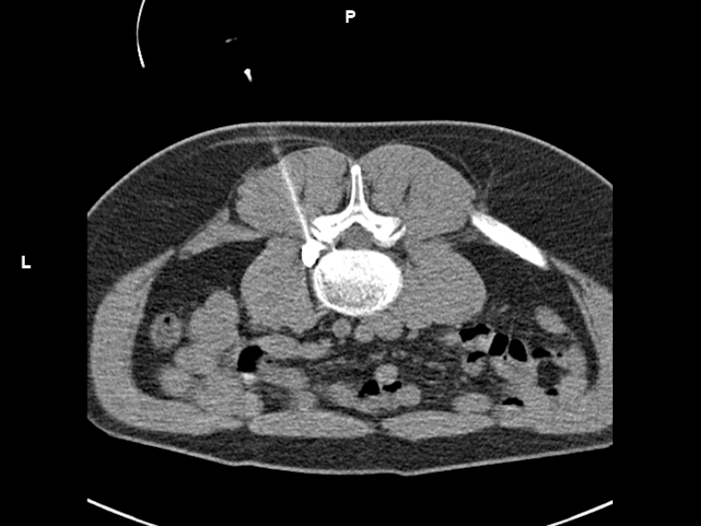 CT image-guided pain therapy at the lumbar spineusing SOMATOM X.cite and myNeedle Guide; Axial view, i-sequence