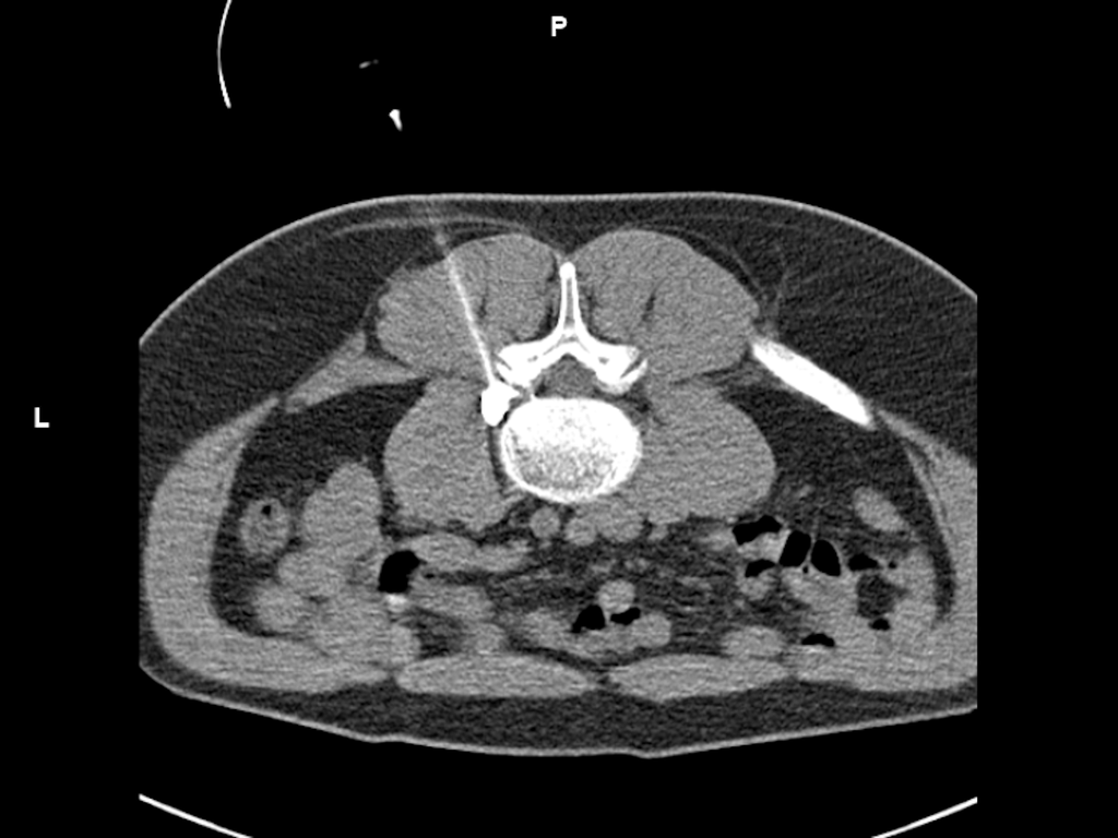 CT-guided interventions - Siemens Healthineers