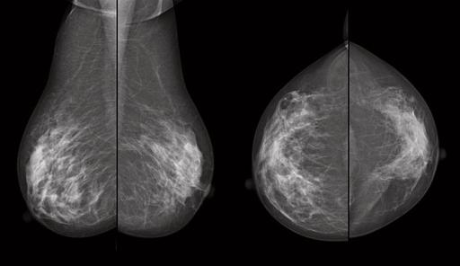 Invasive Ductal Carcinoma (IDC) - Role of Tomosynthesis in IDC early ...