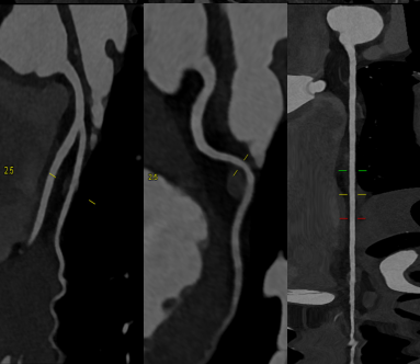 MPR Reformat from 0.4 mm slice thickness1