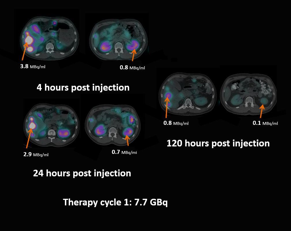 Sequential xSPECT Quant studies determine tracer retention in tumor and kidneys for absorbed dose calculation