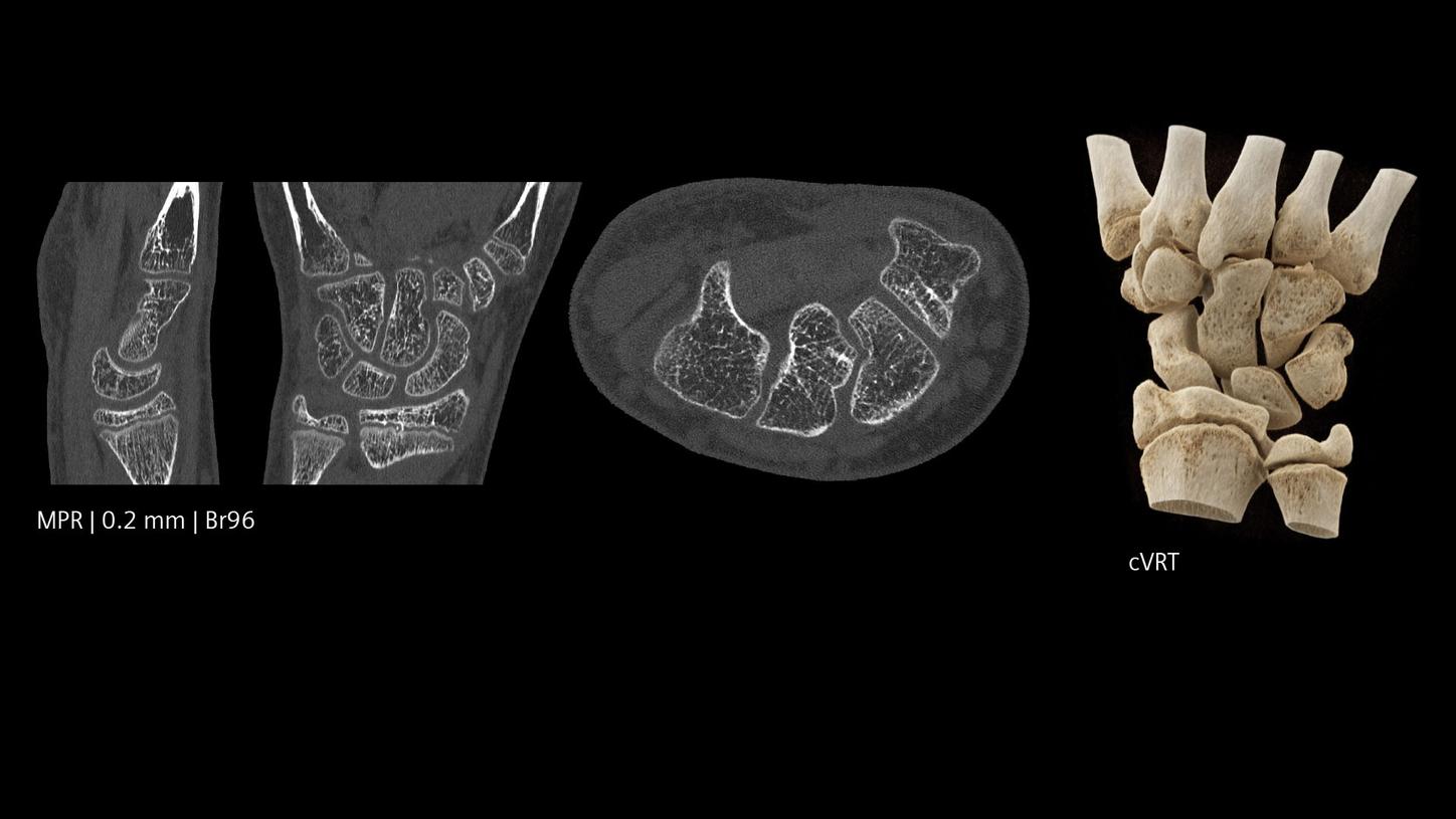 Pediatric photon-counting CT scan of a wrist