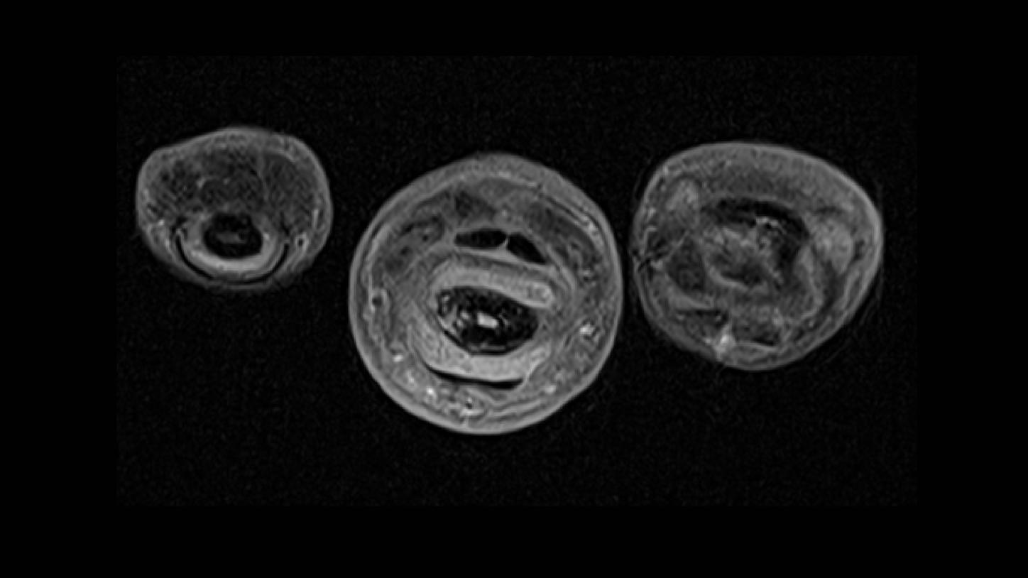 CT image of retro-ocular masses causing exophthalmos along with bilateral perinephric, pericardial, and pelvic exudates