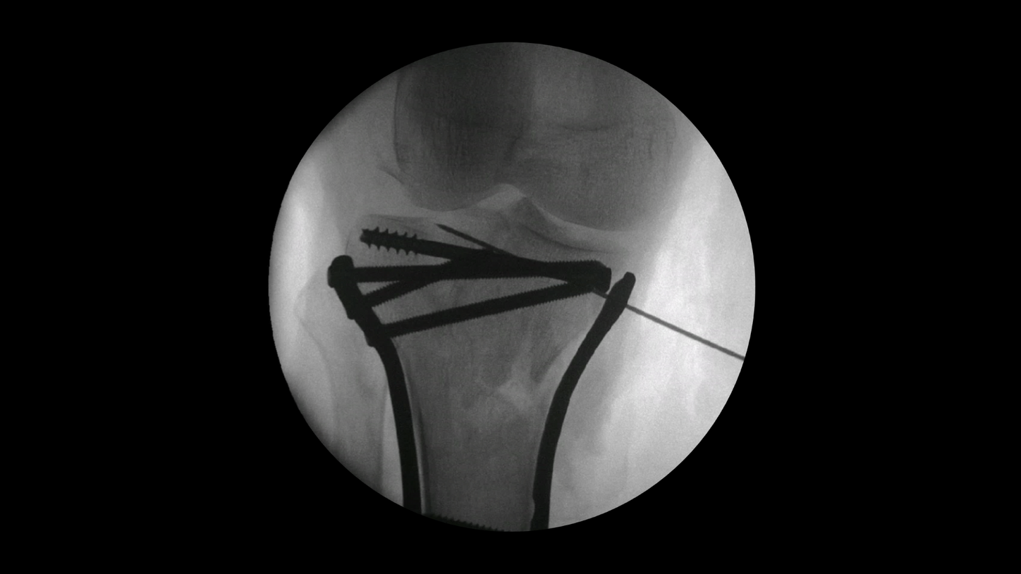 Proximal tibia surgery with Cios Fit, a mobile 2D C-arm for surgery.