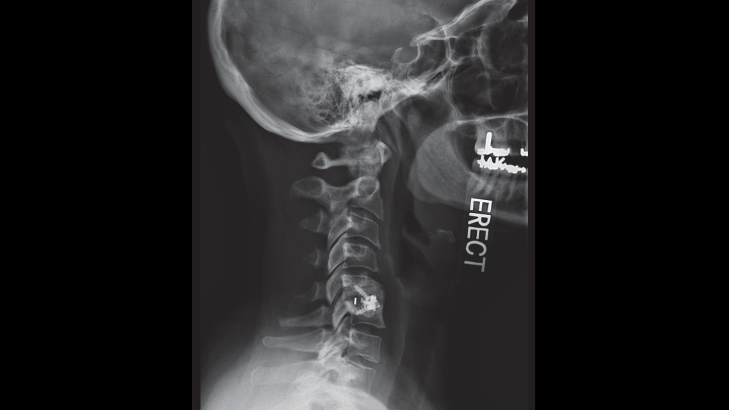 Cervical X-ray shows intact ACDF fusion instrumentation.