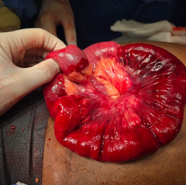 Fig. 12: Intraoperative image demonstrating an ischemic segment of small bowel with a clearly defined transi- tion point to adjacent normal-appearing small intestine.