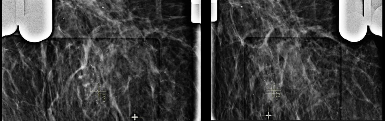 Imagem de par de estereotaxia