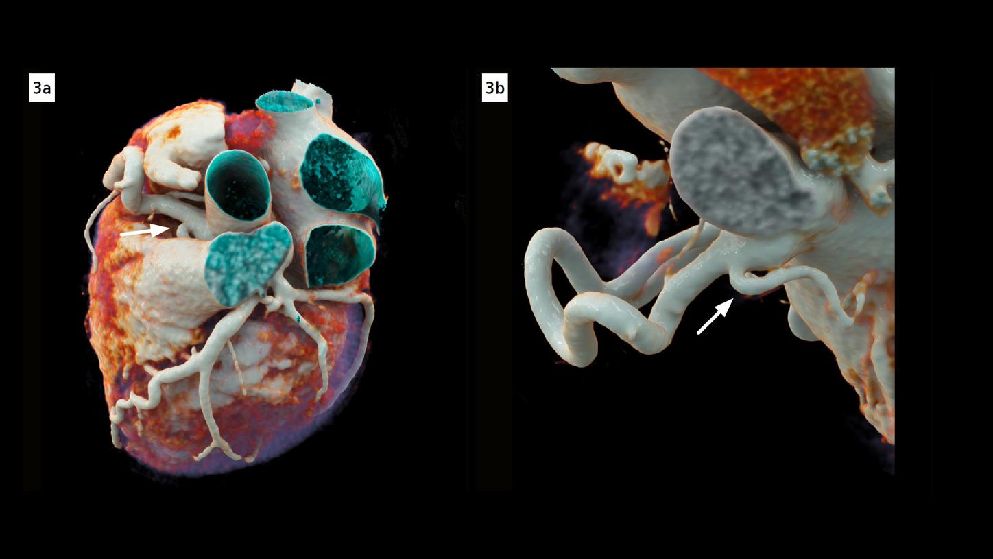 cVRT images show an enlarged DSA branching out of the proximal RCA. Both left and right coronary arteries are dilated and tortuous.