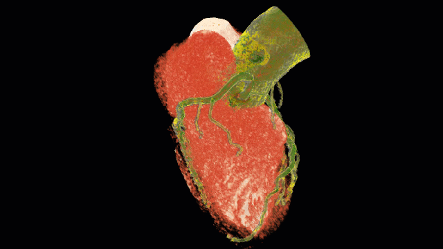 clinical_proof_3_ct1_heart