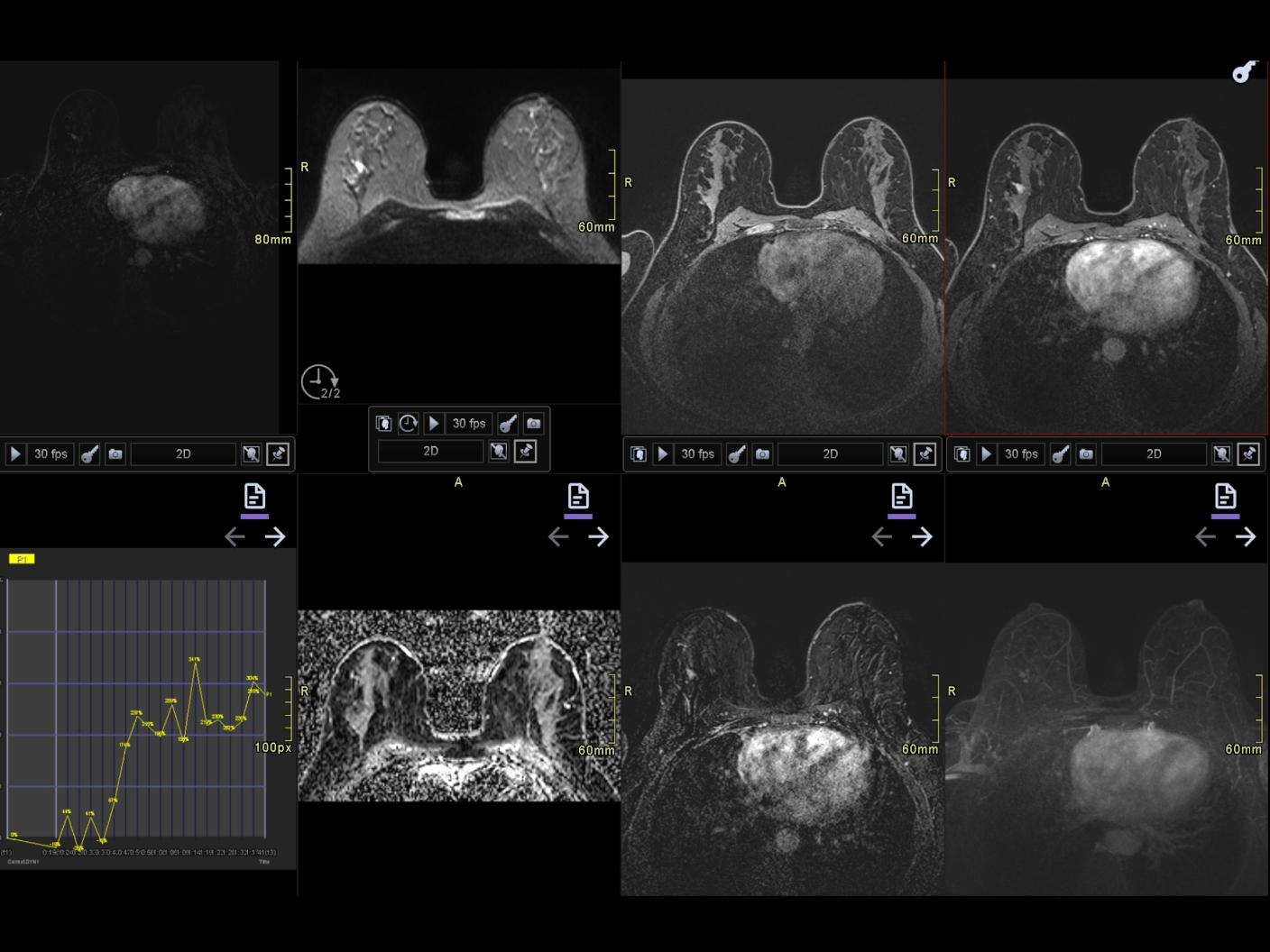 Abbreviated Breast MR Protocol at Radboud University