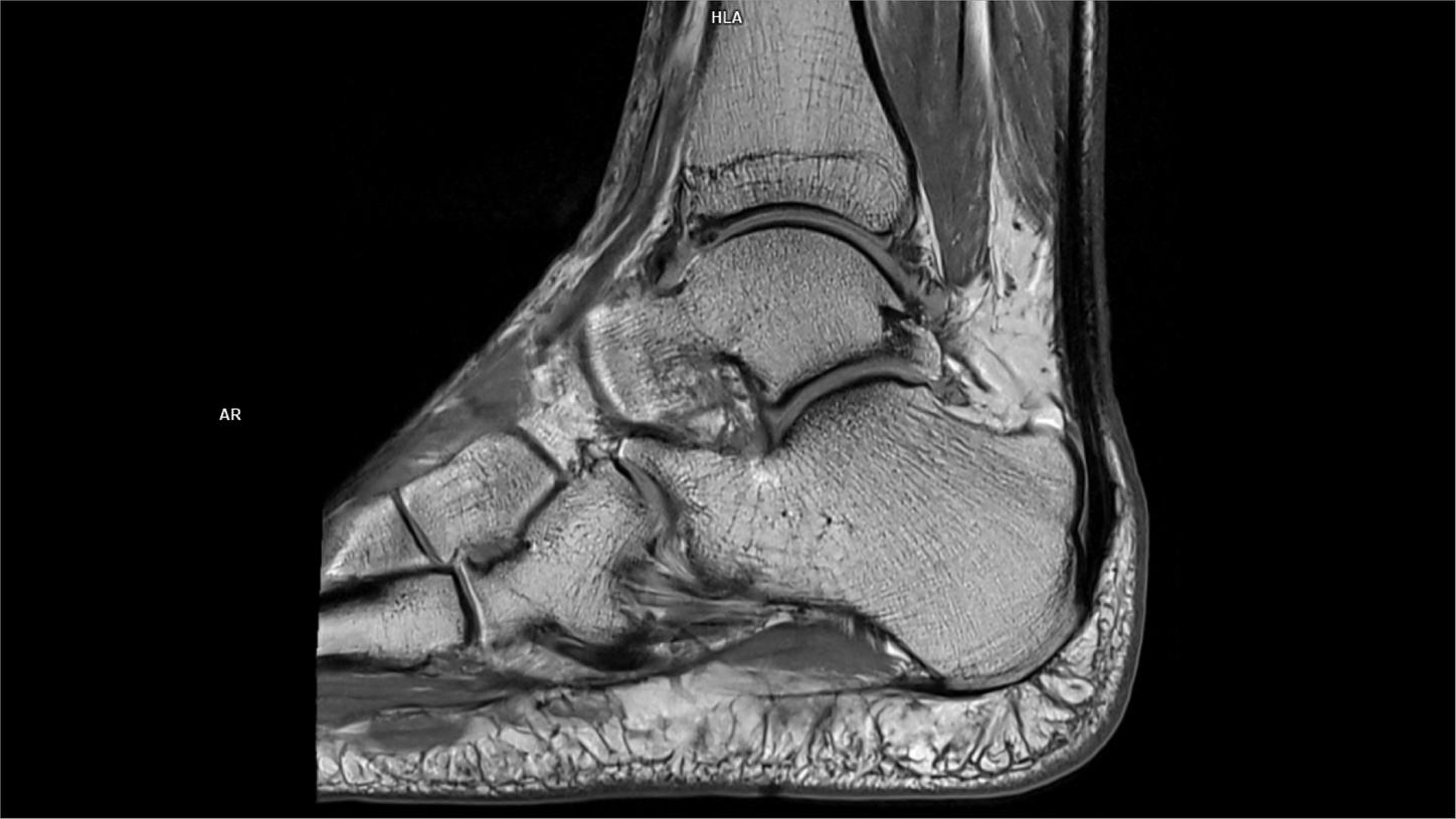 Sagittal T1 tse DR Sharp-MAGNETOM Vida/Coil-Foot Ankle 16/Resolution-896/Scan Time-1:29/Aceleration-p3 DR