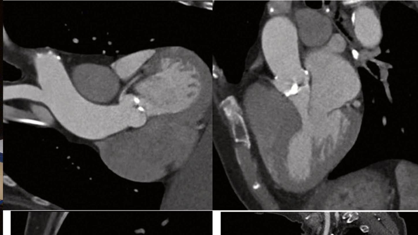 Cardiac CT with Somaris 10