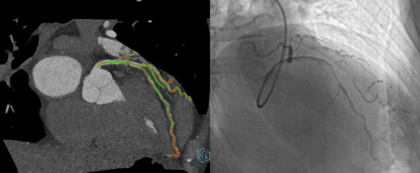 syngo CTO Guidance, displayed side by side with fluoroscopy, showing the second desired angulation, with the wire successfully crossing the occluded LAD segment.
