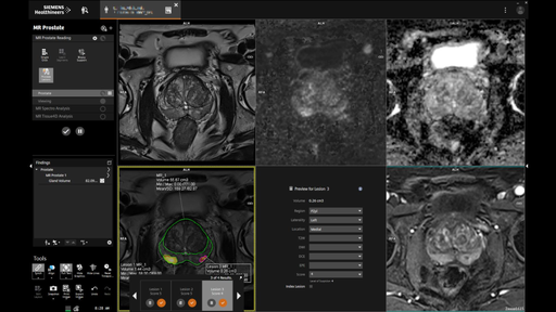 MR Prostate – AI-based segmentation and classification
