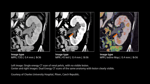 Computed Tomography for Oncology - Siemens Healthineers