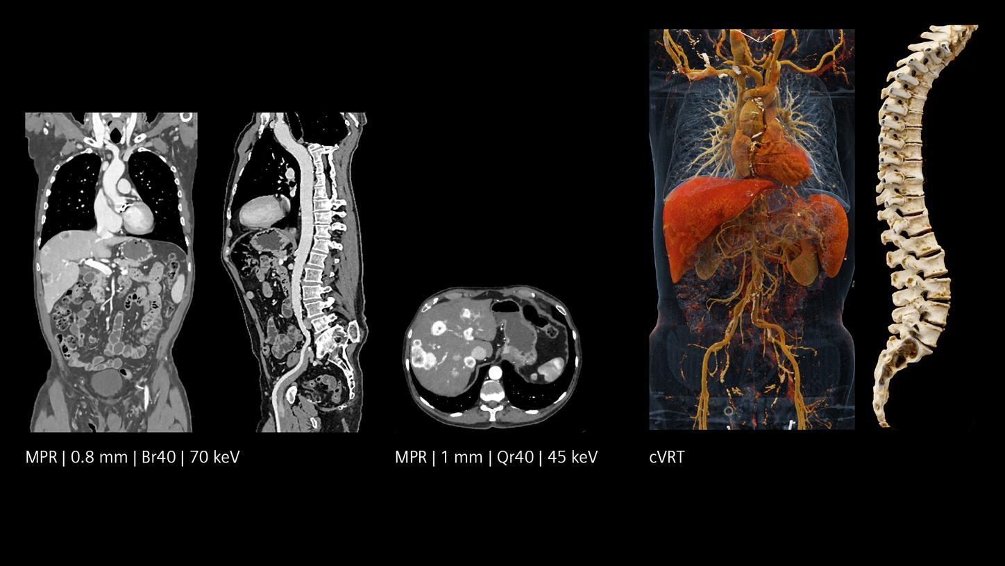Whole-body scan, MPR and cVRT: spectral information and low dose for oncology assessment.