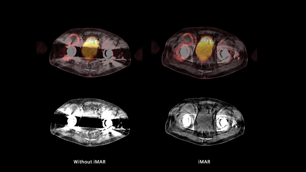 Biograph Vision clinical case