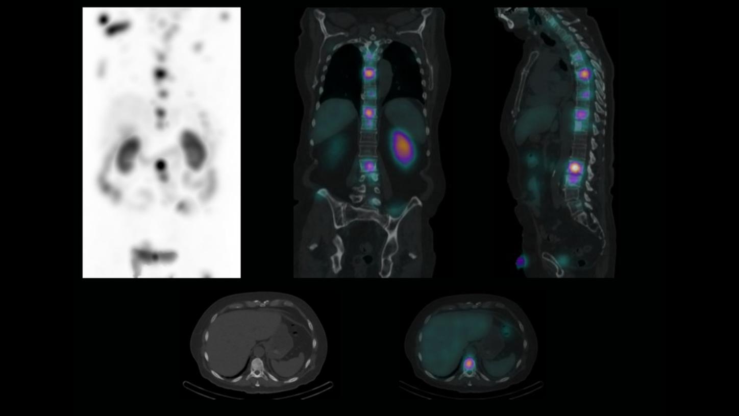 SPECT/CT confirmed that the treatment was irradiating metastatic disease.