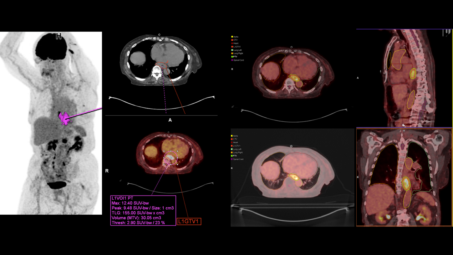 Esophageal Cancer — Thoracic RT