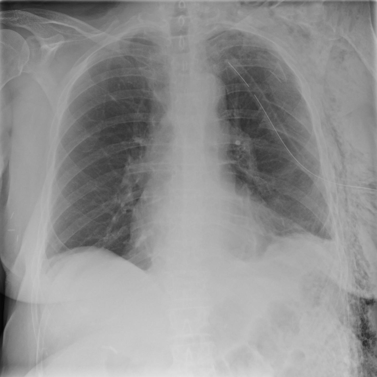 X-ray of a chest