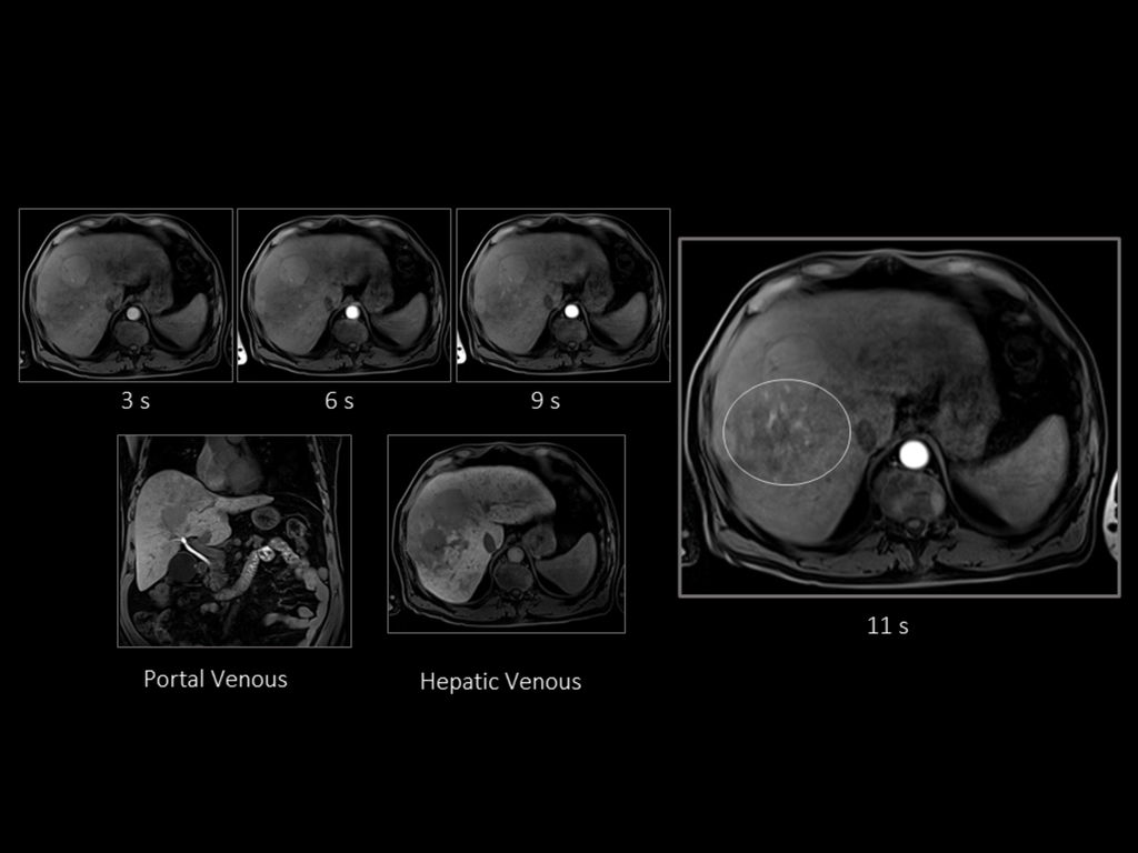 Liver Cancer Siemens Healthineers Slovakia