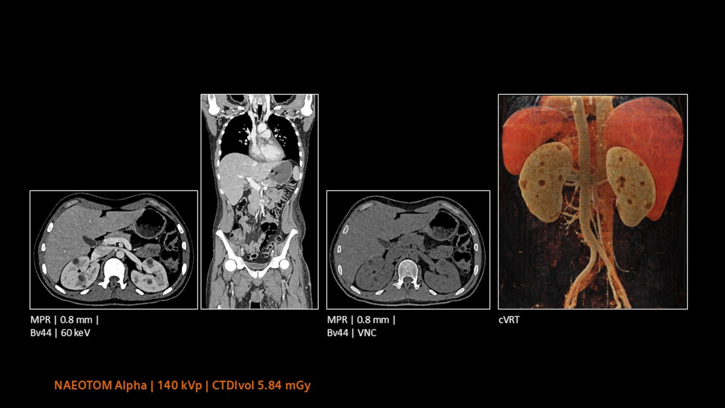 Quantum Spectral Imaging - The NAEOTOM Alpha class permits evaluation of kidney cysts  in a single-phase scan.