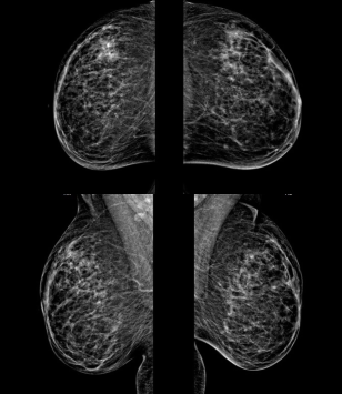 Image A: Mammogram images of both breasts, obtained in bilateral MLO and CC views. The images show scattered round isodense masses in the upper outer and lower inner quadrants of the left breast, as well as in the lower inner quadrant of the right breast.