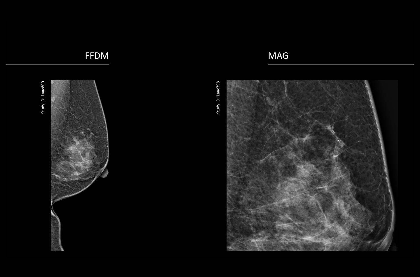 Microcalcificaciones mamarias benignas asociadas a cambios fibroquísticos