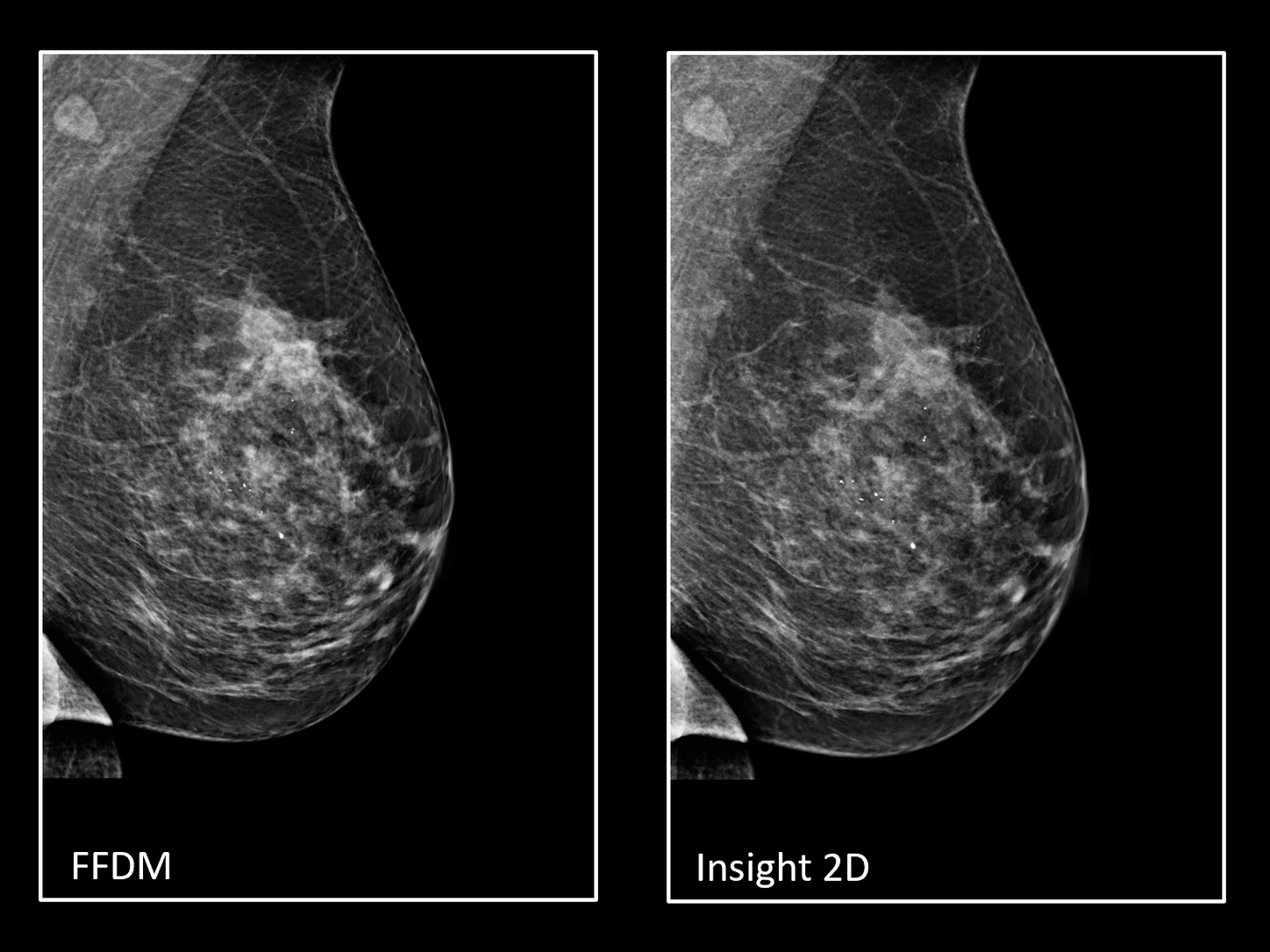 comparison of FFDM and insight2D