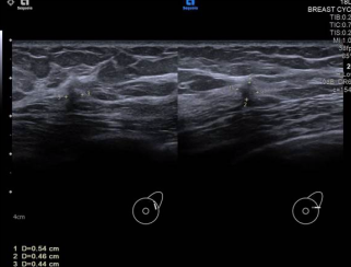 Image A: Ultrasound image reveals a 0.5 cm irregular hypoechoic mass with angular margins located at the deep upper outer quadrant of the left breast.