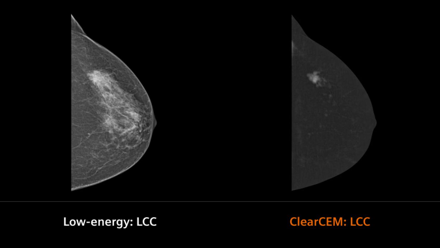 Clinical image breast
