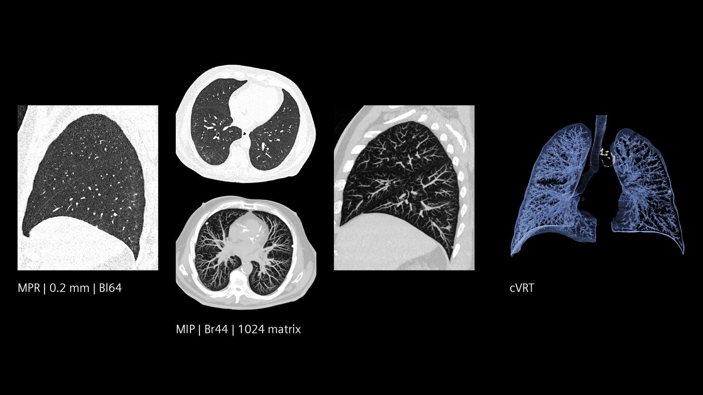 Low dose and Quantum HD lung imaging