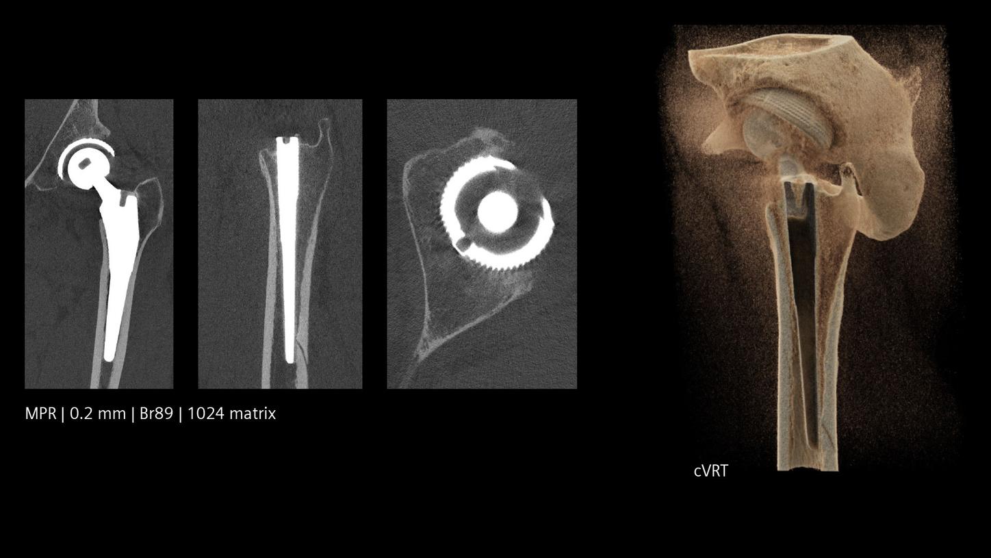 Photon-counting CT scan of a hip prosthesis with Quantum HD imaging and metal artifacts reduction 
