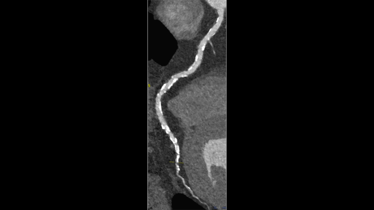48 year old Male Patient - Coronary Artery 