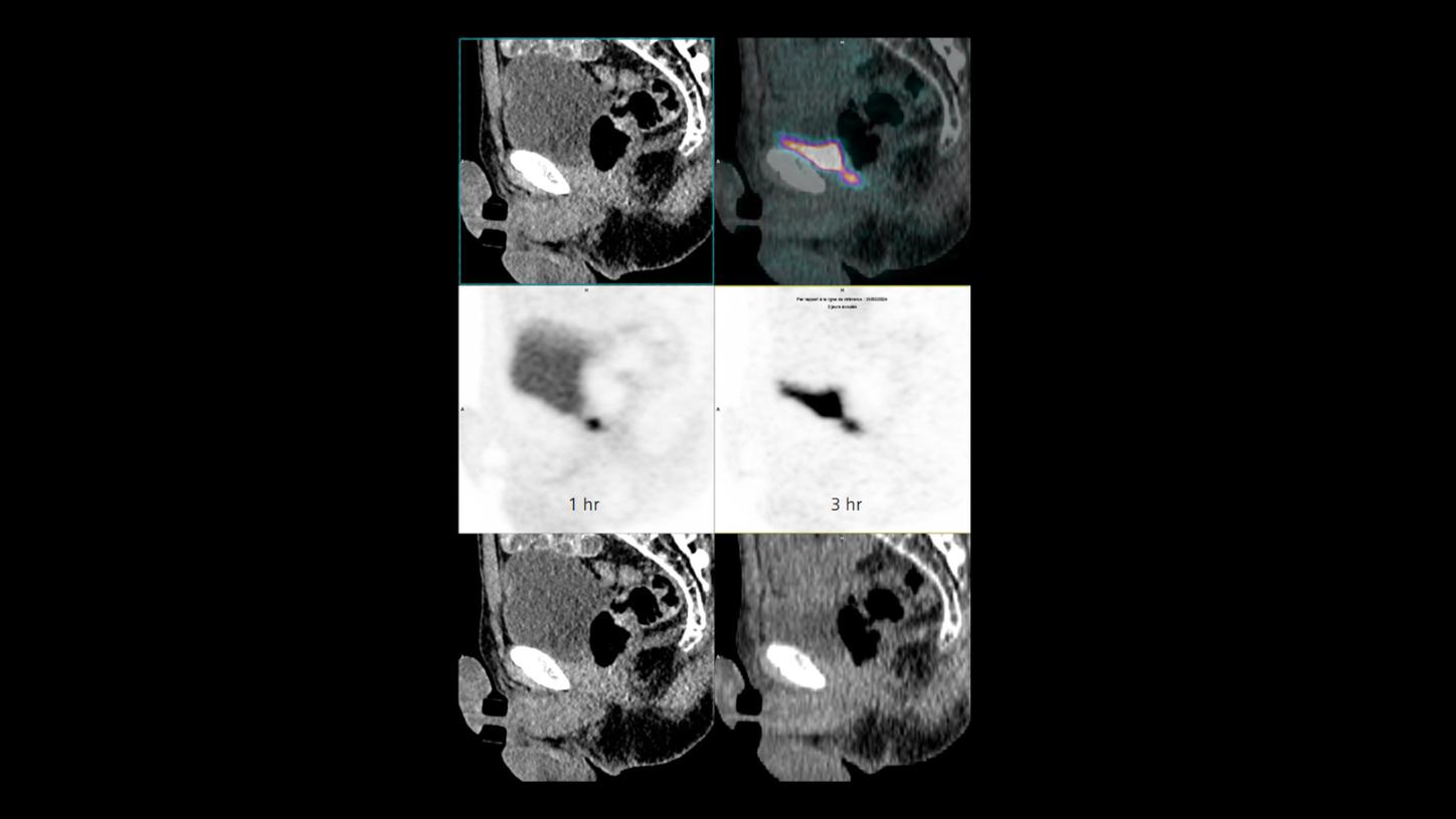 Centre Hospital Universitaire often does a 3-hour post-injection scan in case of biochemical recurrence indication after prostatectomy.