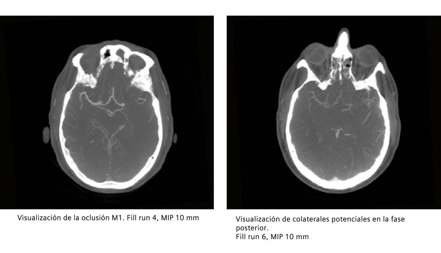 Visualización de vasos colaterales para trombectomía en ACV